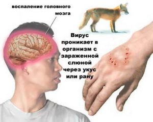 Бешенство у человека-признаки